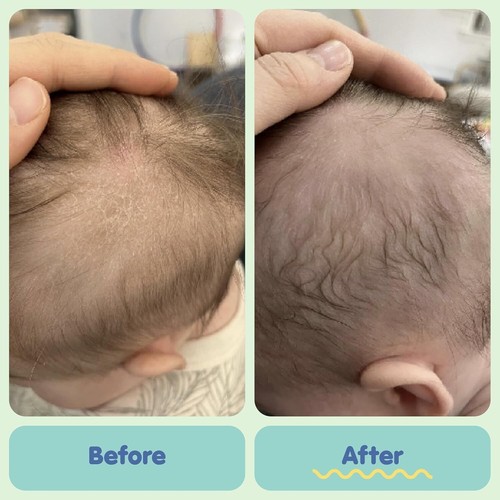Tubby Todd Cradle Cap Bundle – Gel, Wash, Lotion, Ointment & Brush Se - Picture 4 of 4