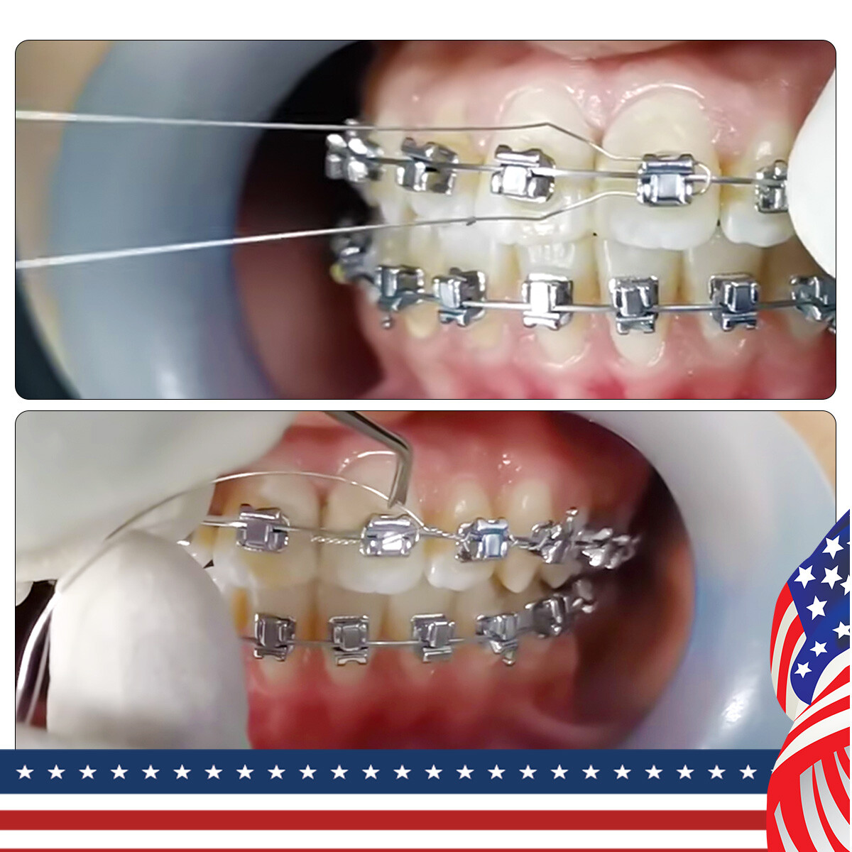 Azdent Dental Kobayashi Ligature Ties Long Short Twist Orthodontic Wire