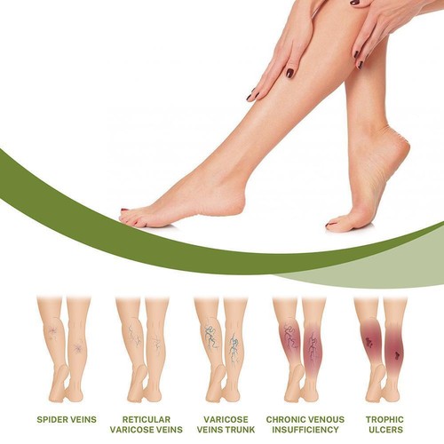 Varicose Veins Cream Blood Circulation Vein Defense Cream Body Leg Care H3X7 - Bild 7 von 12