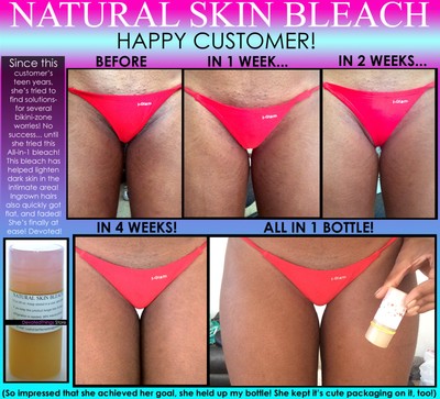 bleaching stretch marks