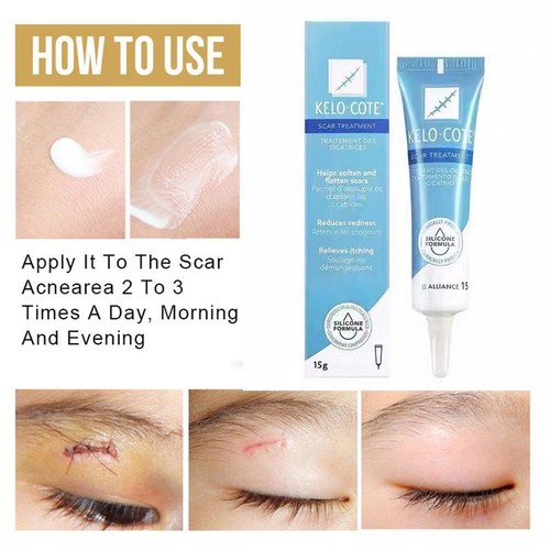 Scar Removal Cream For Repairing Burns and Removing Scars\ - 第 7/9 張圖片