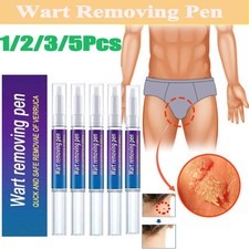 Wart Liquid Hand Foot Warts Remove Filiform Wart Flat Warts Condyloma Acuminatum