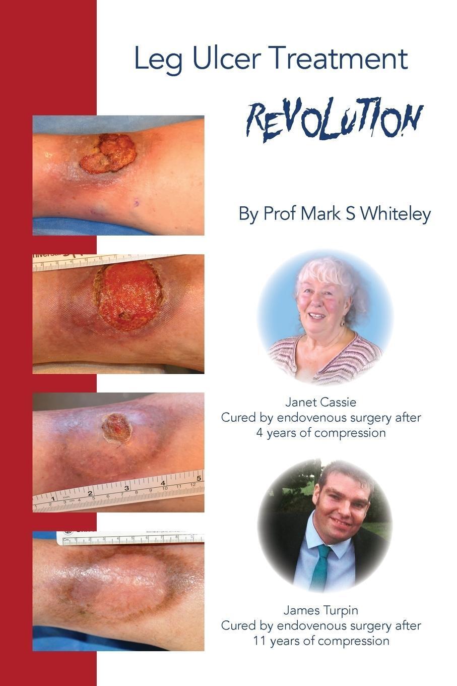 Thumbnail - Leg Ulcer Treatment Revolution | Mark S Whiteley | Taschenbuch |