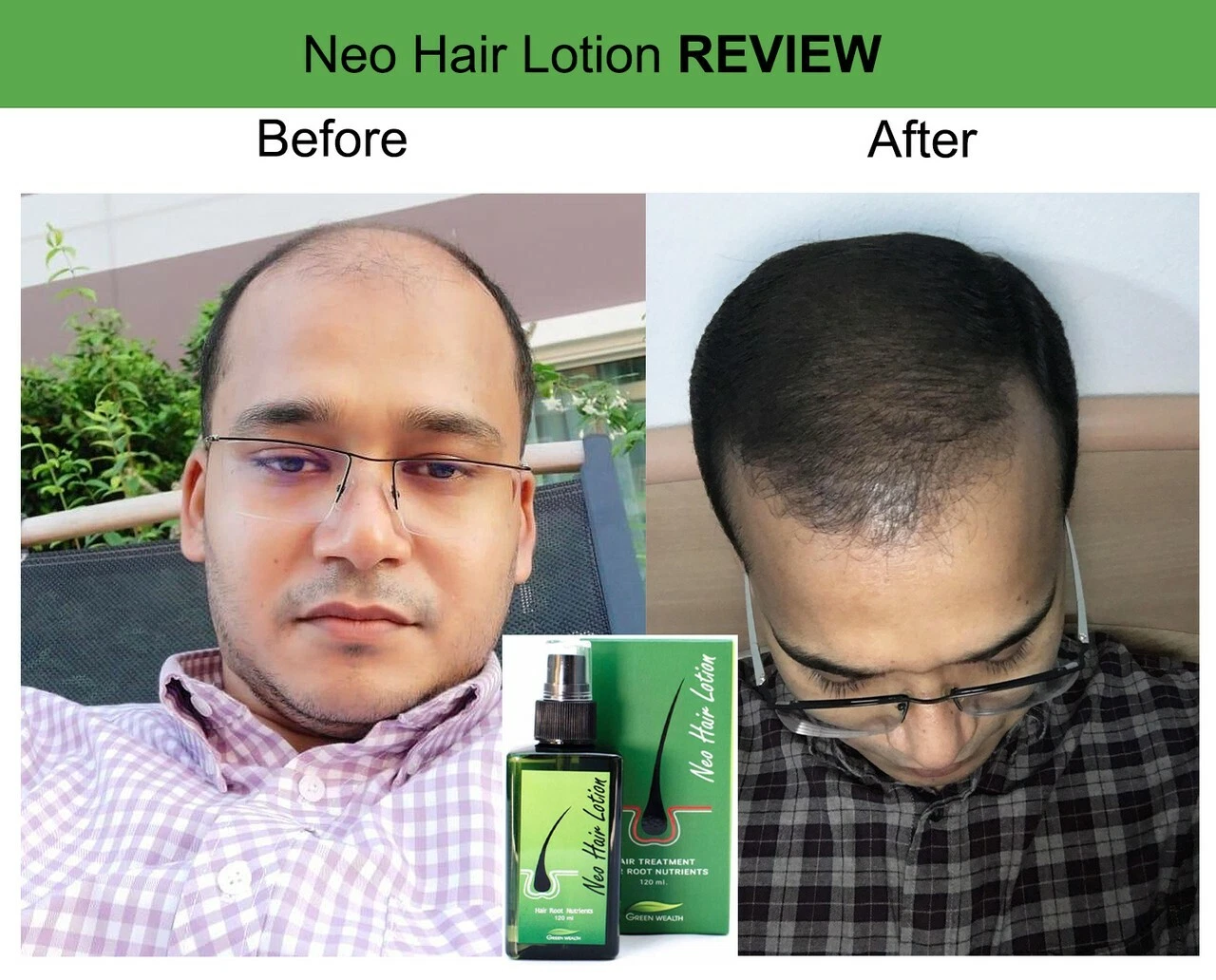 120ml Neo Hair Lotion 100% Original Authentic
Opens in a new window or tab