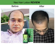 120ml Neo Hair Lotion 100% Original Authentic