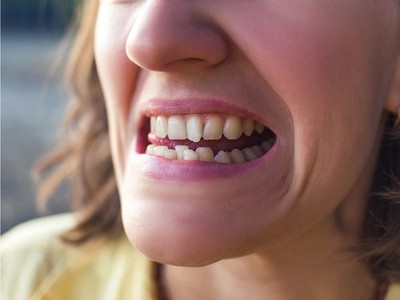 Orthodontic Relapse - UPPER  Active Retainer. Ideal after Invisalign