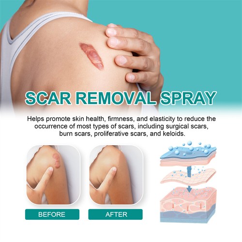 Scar Removal Spray Medical Grade Smoothing for Pregnancy Surgical Scars Burns~ - Picture 6 of 9
