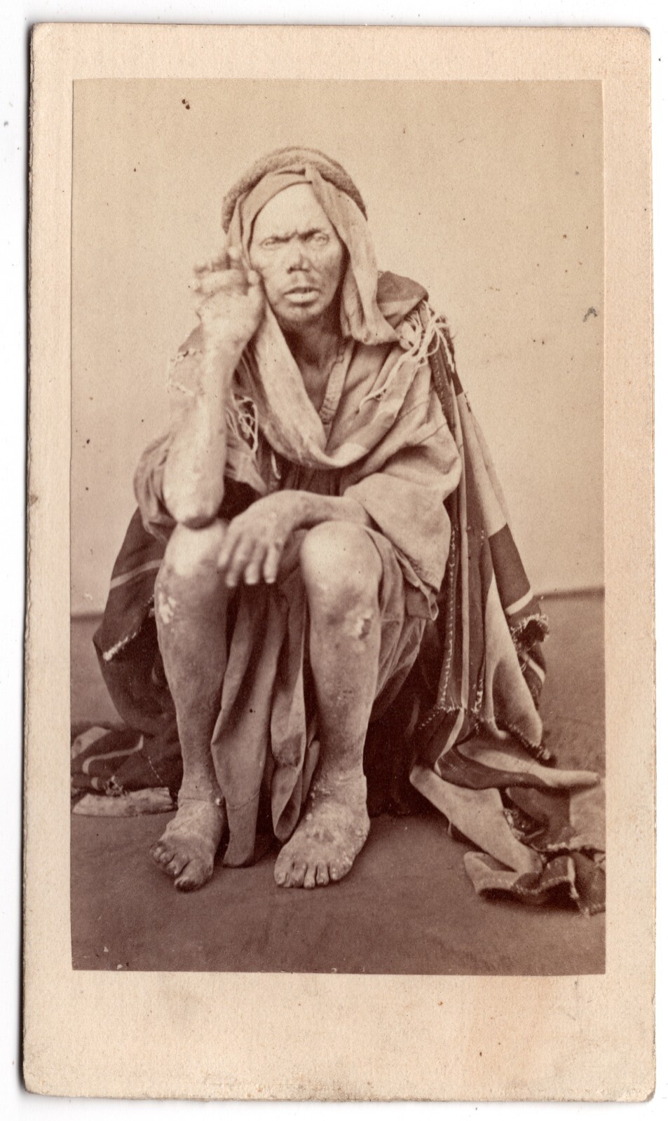 ANTIQUE CDV CIRCA 1860s MAN WITH LEPROSY SICK IN THE MIDDLE EAST RARE!