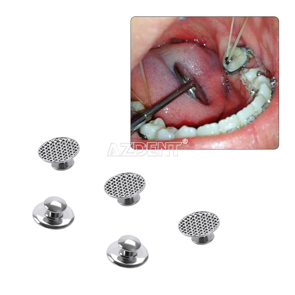 100 Pezzi AZDENT Bottoni Linguali Ortodontici Dentali Base A Rete - Foto 4