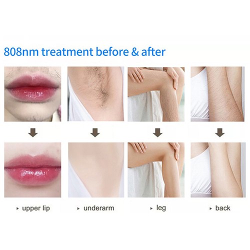755NM+808NM+1064NM Diode Laser Tattoo Hair Removal Facial Rejuvenation Machine - Picture 10 of 15