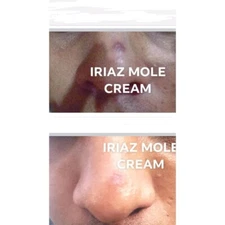 Skin Tag, Mole, Wart & Corn Removal Solution – 8ml Fast Acting Natural Topic