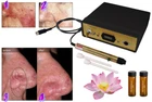 Laser Spider Vein Capillary Removal Machine + Gel Kit, System, Bio Avance