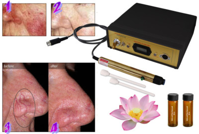 Laser Spider Vein Capillary Removal Machine + Gel Kit, System, Bio Avance 