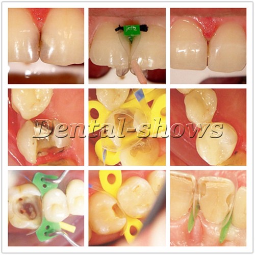 Dental Transparent Plastic 5/7mm Matrix Sectional Contoured Matrices 1.922/1.923 - Imagen 2 de 7