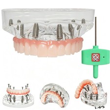 Dental implant Teeth Model Demo Overdenture All-On-6 treatment upper jaw 6Screws