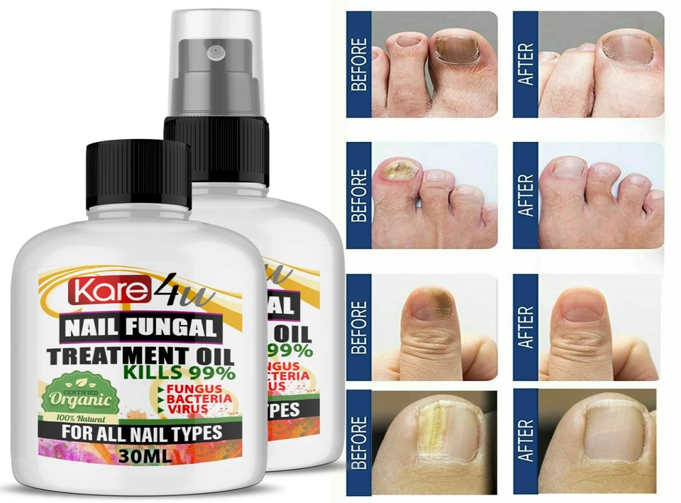 30ML Fungal Nail Treatment Highly Effective Kill Nail Fungus For Best Result UK