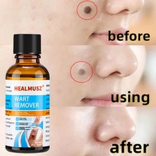 Wart Remover Fast Acting and Painless,Mole Remover Liquid for Face, Hands & Body
