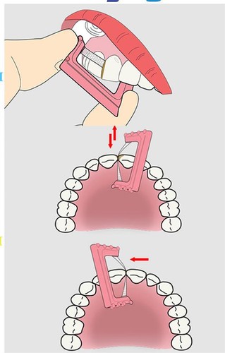 10pc Dental Interproximal Enamel Reduction Kit IPR Polishing Strip Serrated Saw - Picture 14 of 21