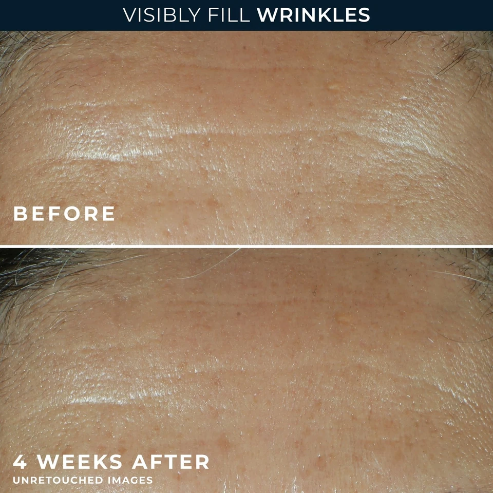 Retinol Correxion Wrinkle Filler for Deep Wrinkles with Hyaluronic Acid & Ret... - Image 4 of 4