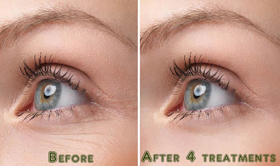 100% Pure Hyaluronic Acid Serum HA Anti Aging Intense Anti Wrinkle Moisturizer - Image 2 of 3