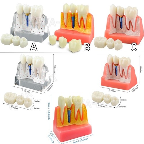 Dental Demonstration Removable Teeth Model – Implant Analysis Crown Bridge Study