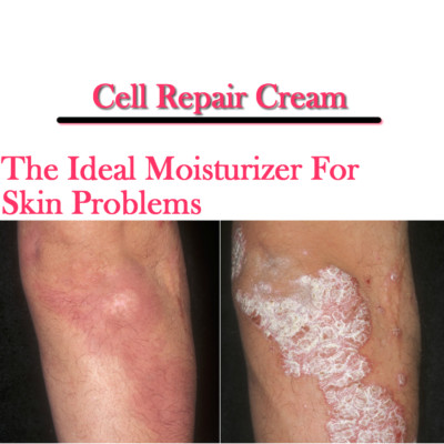 Zellreparaturcreme - juckende Haut Hautausschlag Ekzem & Psoriasis trockene Haut feuchtigkeitsspendend