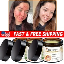 Bee Venom Skin Tag Removal Treatment Cream Body Care Mole Corn Wart Remover-2025
