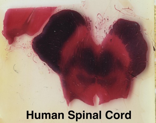 NEUROBIOLOGY Microscope Slide Set HUMAN BRAIN+OCULAR CNS Disease Tumor Neurology - Picture 8 of 11