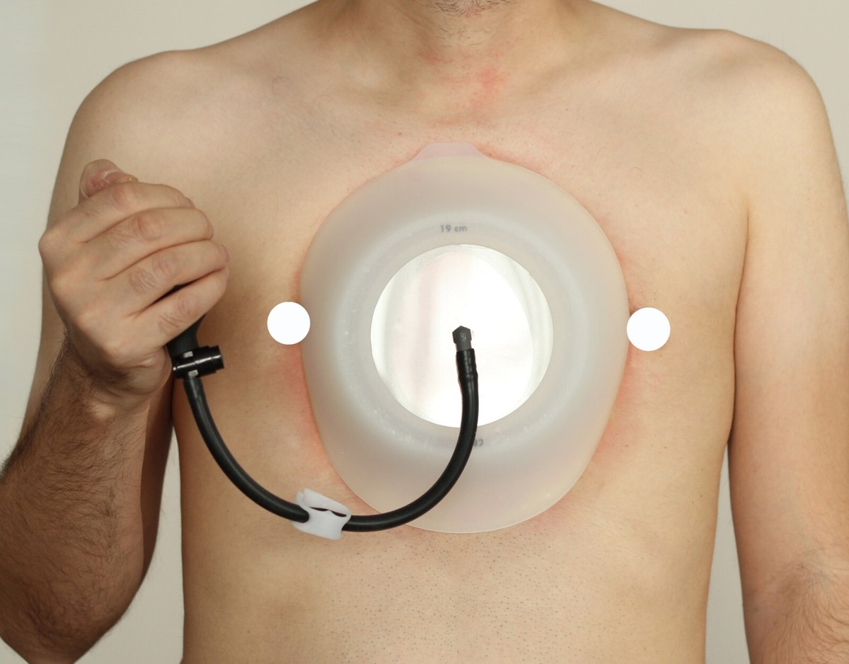 Vacuum Bell 19cm (XL) Pectus Excavatum | eBay