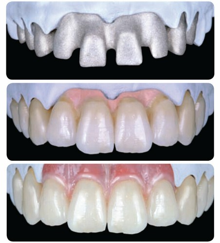 Dental Parafil compuesto chicle kit de sombra LC rosa restauración mancha - Imagen 2 de 8