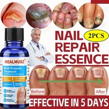 2x Anti-Fungal Maximum Strength Toenail Fungus Athletes Foot Fungi Nail Support