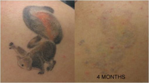  Tattoo Removal Cream Natural Fading system wrecking balm 2 week  spartan perform : Beauty & Personal Care