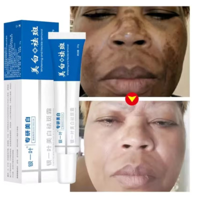 Effective Whitening Freckle Cream Remove Dark Spot Cream Removal Melanin Melasma