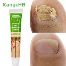 Foot Nail Fungus Treatment Cream Antifungal Ointment Onychomycosis Care