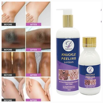 Strong Whitening Cream Lotion  Removing Dark Knuckle Finger Elbow Knee Bleaching