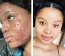 2 Skin Lightening Cream Extra Strength Lighter FAST Result-NO SIDE EFFECTS