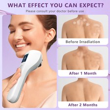 Home Phototherapy UVB Light Lamp Device for Skin Diseases Treatment 308nm