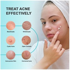 Acne Spot Treatment Cream: Hormonal Breakouts Control