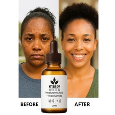 Kojic Acid Face Serum with Vitamin E Skin Brightening Anti Dark Spots 30ml