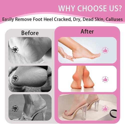 Electric Foot Callus Remover,Foot Scrubber & Callus Remover for Feet Foot Spa... - Picture 2 of 8