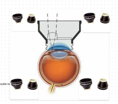 YAG Iridectomy And YAG Capsulotomy Lens For YAG Laser surgery