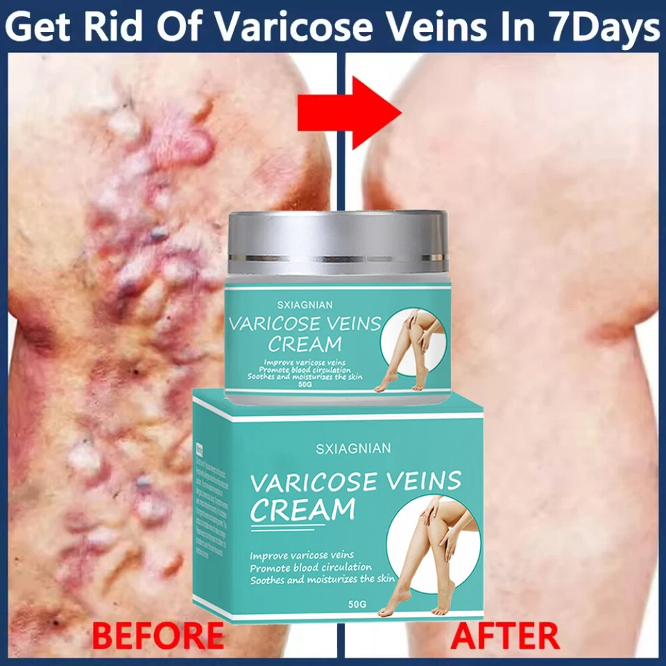 SXIAGNIAN Varicose Vein Relief Cream Eliminate Natural Varicose Veins and Spider Veins 50g