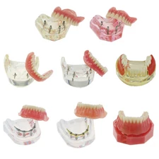 Dental Implant Overdenture Typodont Model NISSIN Kilgore Style Patient Education