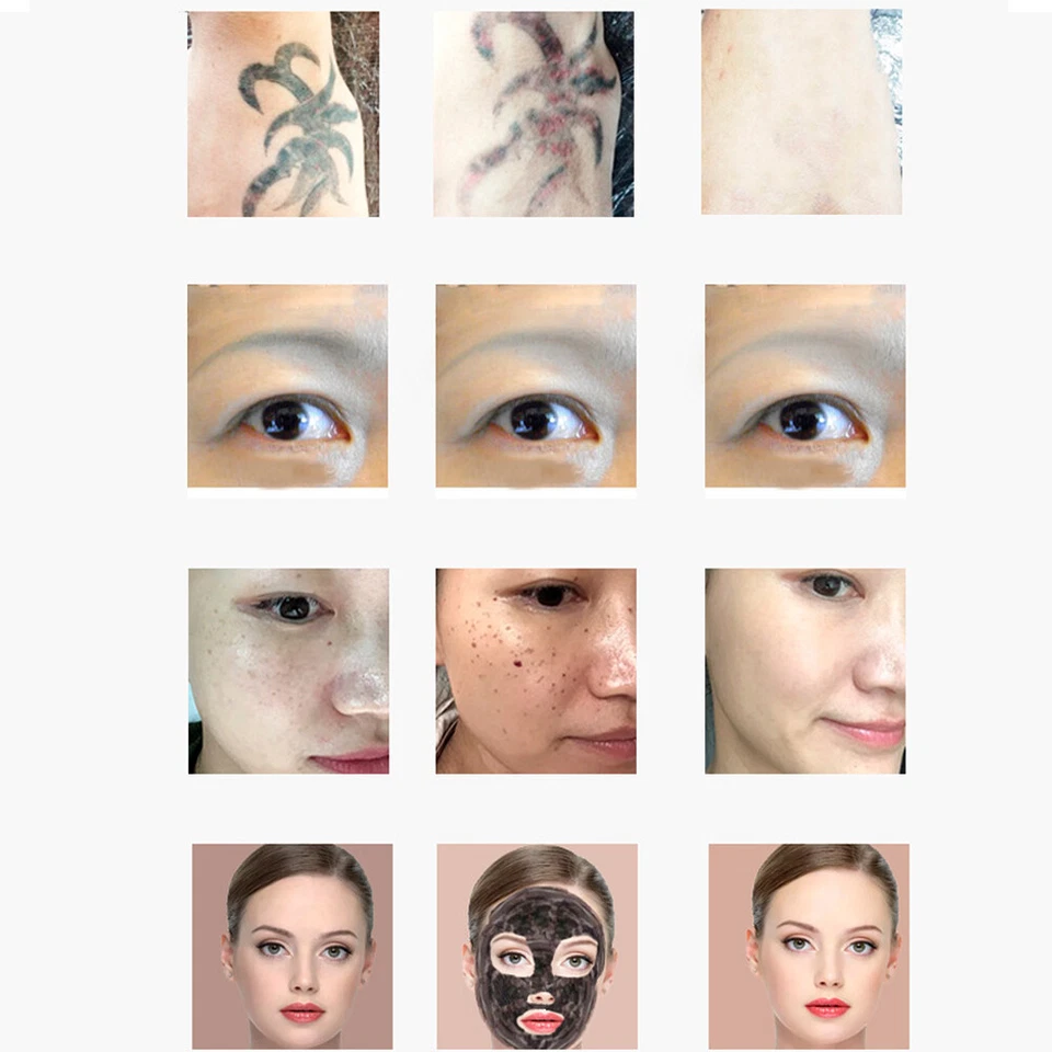 Máquina láser de eliminación de tatuajes de pulso belleza removedor de línea de cejas de picosegundo Nd YAG Foto 4 de 4