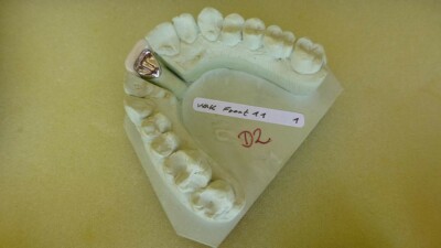 Keramikverblendkrone 11 auf Sägestumpfmodell, abnehmbar, Dental Study Model, 