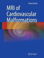 MRI Of Cardiovascular Malformations Bruno Kastler