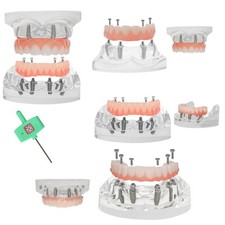 US Dental Implant Model All-on-4 All-on-6 Overdenture U/L Jaw 4/6 Screws Clear