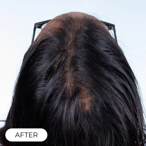 Capillus Plus Laser Therapy Cap For Hair Regrowth Prevents Hair Loss NEW - Picture 5 of 8