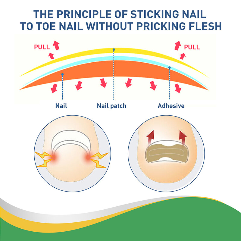 50-150pcs Ingrown Toe Foot Nail Correction Sticker Pedicure Toenail ...