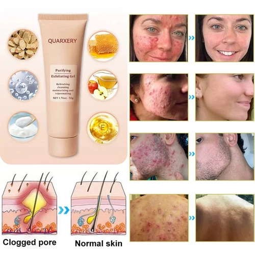 3X Purifying Exfoliating Gel, Quarxery Cleansing Purifying Cream for Face & Body - Bild 4 von 15